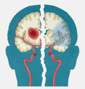 Deteksi Tumor Otak