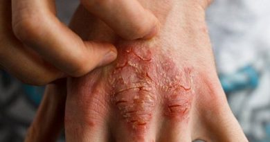 eczema